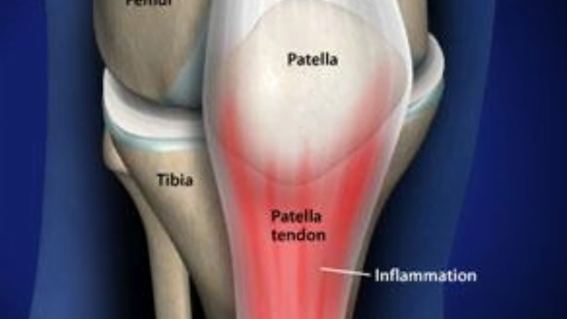 lutut sakit ditekuk - tendonitis